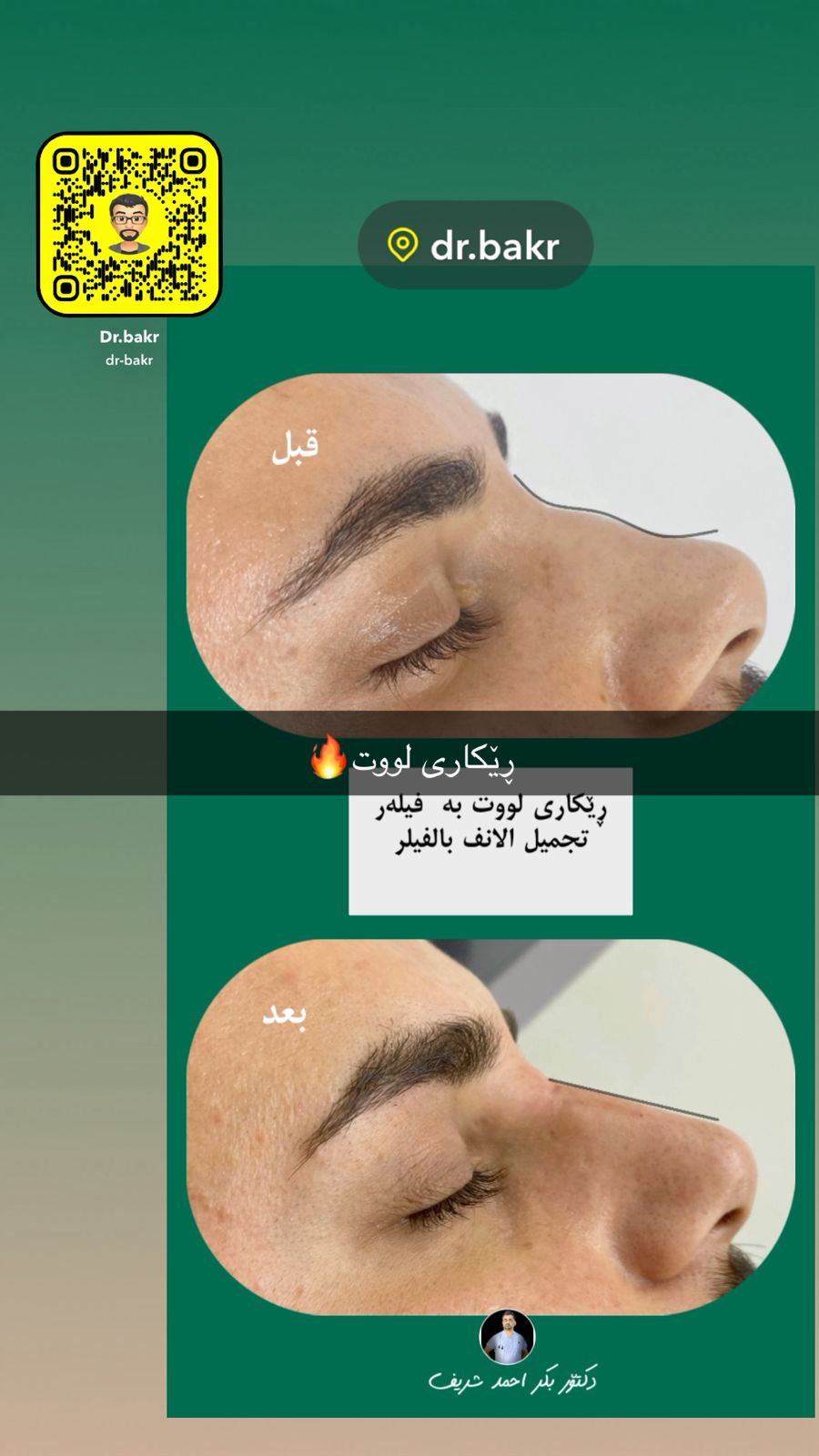 ڕاستکردنەوەی لووت بێ نەشتەرگەری بە فیلەر