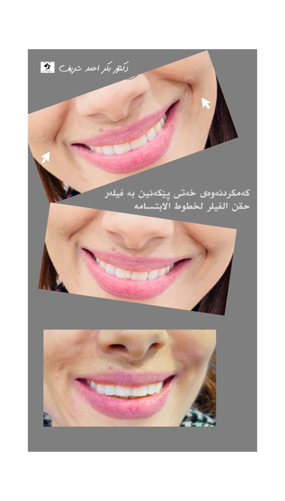 فیلەری هێڵی پێکەنین